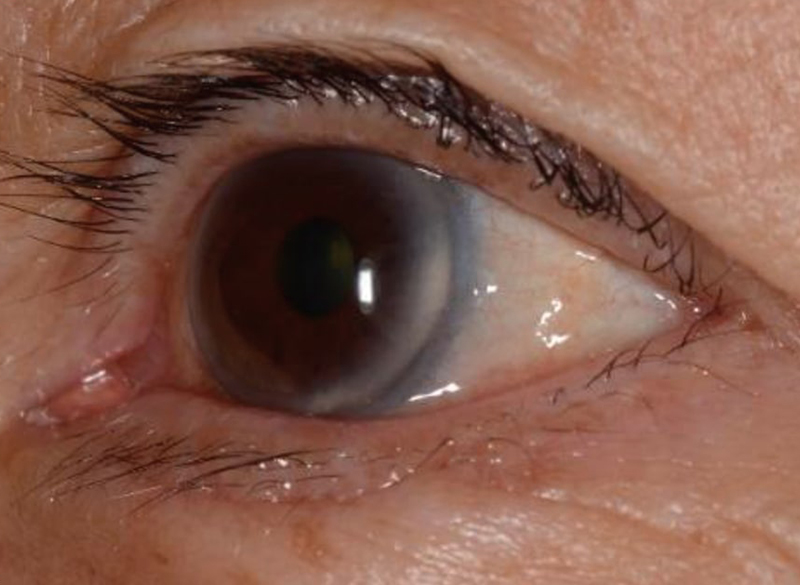 眼瞼・涙道疾患